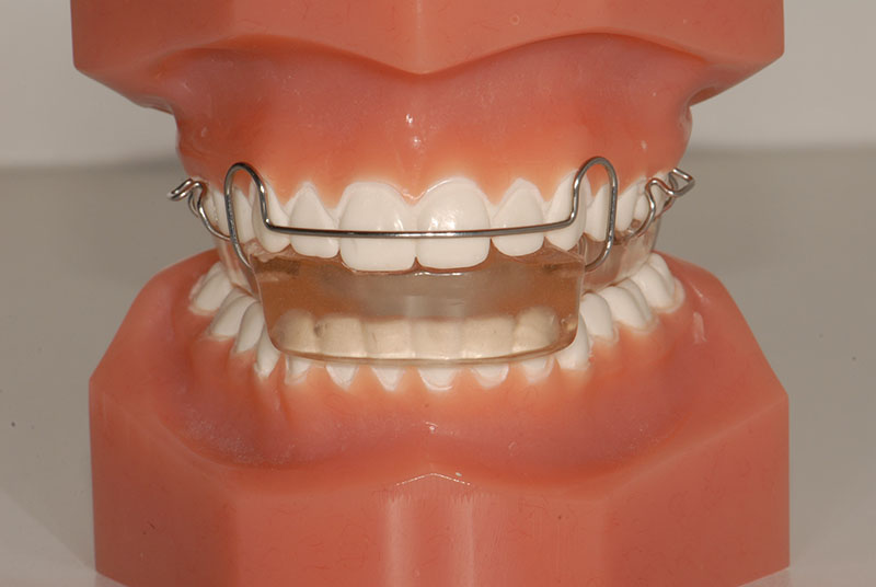 Emuleren Schema Opeenvolgend Orthodontie - Elementen mondzorg