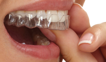 NIEUW bij Elementen Aligners en vaste beugel - Elementen mondzorg